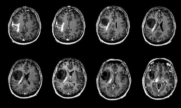 Beyin Tümörü İlaçları Kullanımı ve Faydaları Nelerdir?