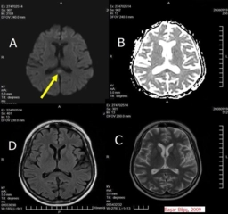 Beyin Lezyonu Belirtileri ve Tedavisi