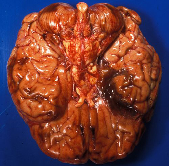 Beyin İltihabı Belirtileri ve Tedavisi