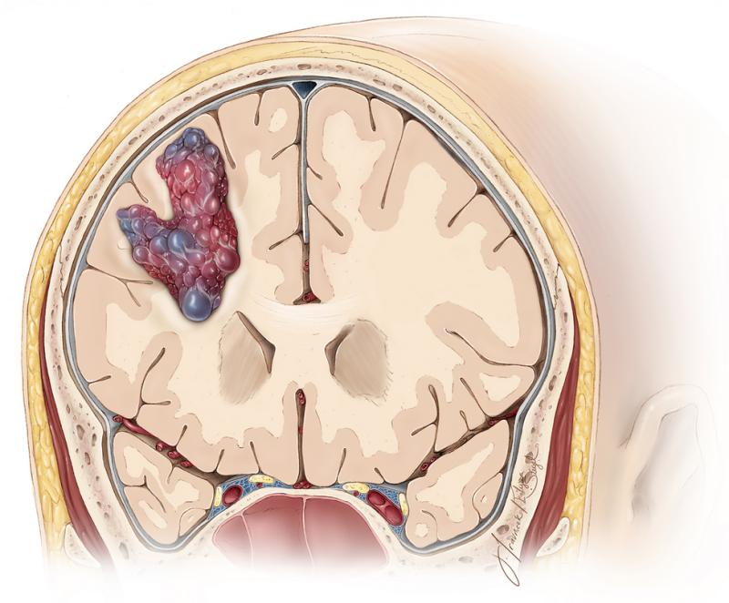 Kavernomlar Nedir? Riskleri ve Tedavisi